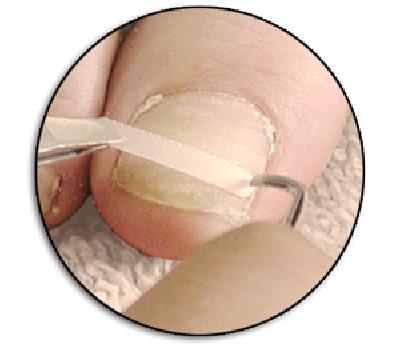 LCN Ingrown Toenail Brace, Size 16, 2pcs